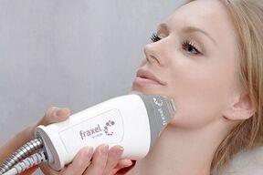 La esencia del procedimiento de rejuvenecimiento fraccional de la piel del rostro.