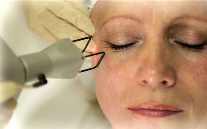 eliminación con láser de arrugas alrededor de los ojos